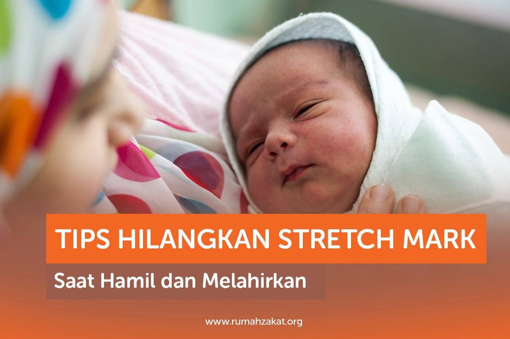 TIPS HILANGKAN STRETCH MARK SAAT HAMIL DAN MELAHIRKAN